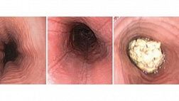 ЭОЗИНОФИЛЬНЫЙ ЭЗОФАГИТ: ДИАГНОСТИЧЕСКИЕ КРИТЕРИИ И КЛИНИЧЕСКИЙ ПРИМЕР 2011